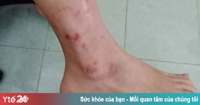Biến chứng da do tùy tiện dùng Corticoid bôi ngoài da - Ảnh 1. Biến chứng da do tùy tiện dùng Corticoid bôi ngoài da - Ảnh 1.