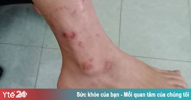 Biến chứng da do tùy tiện dùng Corticoid bôi ngoài da - Ảnh 1.