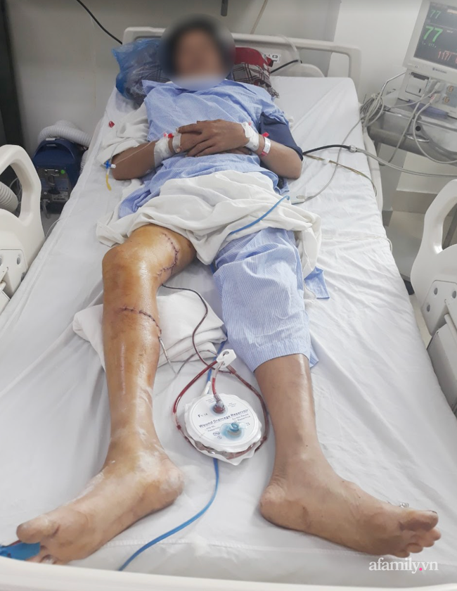 Tai nạn kinh hoàng: Người đàn ông bị máy cưa cắt thẳng vào đùi và cẳng chân mất máu nặng, tình trạng nguy kịch - Ảnh 3.