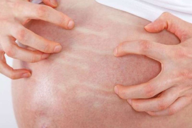 Càng về cuối thai kỳ càng bị ngứa, bà mẹ liền đi xét nghiệm, cầm kết quả trên tay bác sĩ đẩy ngay thai phụ vào phòng mổ khẩn cấp - Ảnh 1. Càng về cuối thai kỳ càng bị ngứa, bà mẹ liền đi xét nghiệm, cầm kết quả trên tay bác sĩ đẩy ngay thai phụ vào phòng mổ khẩn cấp - Ảnh 1.