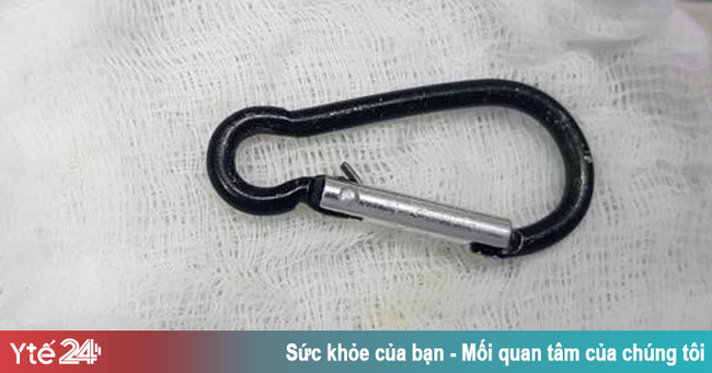 Gắp móc chìa khóa trong dạ dày bé 20 tháng tuổi - Ảnh 1. Gắp móc chìa khóa trong dạ dày bé 20 tháng tuổi - Ảnh 1.