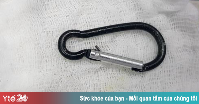 Gắp móc chìa khóa trong dạ dày bé 20 tháng tuổi - Ảnh 1.