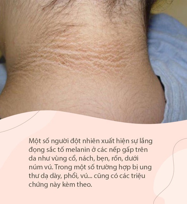 Nếu nhận thấy da có 4 màu sắc bất thường này, đừng nghĩ rằng đó là viêm da, rất có thể đó là tín hiệu của khối u ác tính hoặc ung thư - Ảnh 3.