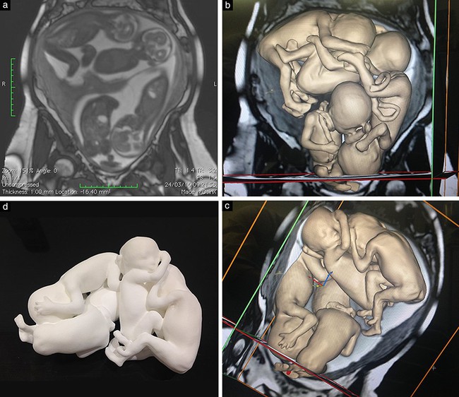 Hình ảnh mô hình vật lý 3D của thai nhi được dựng lại dựa trên kết quả siêu âm khiến nhiều người phải kinh ngạc - Ảnh 2. Hình ảnh mô hình vật lý 3D của thai nhi được dựng lại dựa trên kết quả siêu âm khiến nhiều người phải kinh ngạc - Ảnh 2.