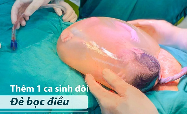 Hiếm gặp một trong hai bé gái song sinh chào đời còn nguyên trong bọc ối - Ảnh 1. Hiếm gặp một trong hai bé gái song sinh chào đời còn nguyên trong bọc ối - Ảnh 1.