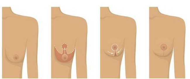 Treo ngực sa trễ: Chuyên gia tiết lộ từ A đến Z, đáng lưu tâm nhất là phẫu thuật có để lại sẹo hay không - Ảnh 1.