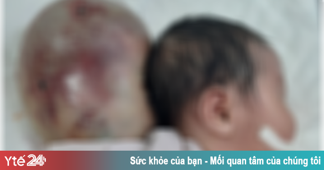 Bé sơ sinh mang khối thoát vị &quot;khổng lồ&quot; sau đầu - Ảnh 1.