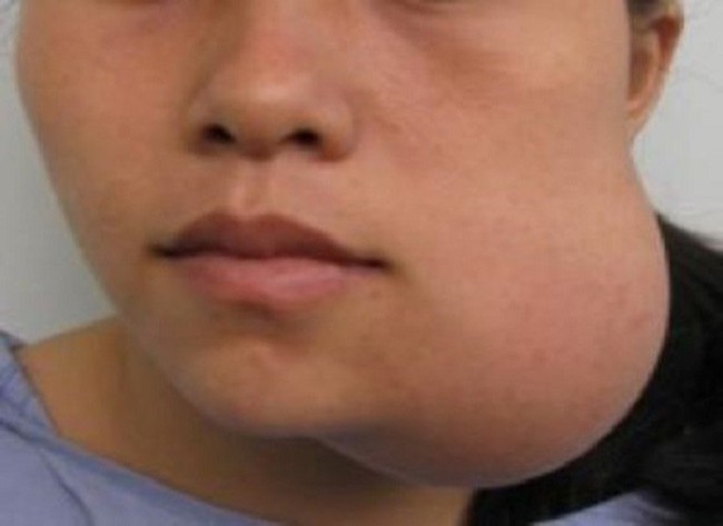 Căn bệnh tiktoker Long Chun đang gặp phải là gì? Triệu chứng dễ gây hiểu lầm sưng răng lợi bình thường   - Ảnh 1.