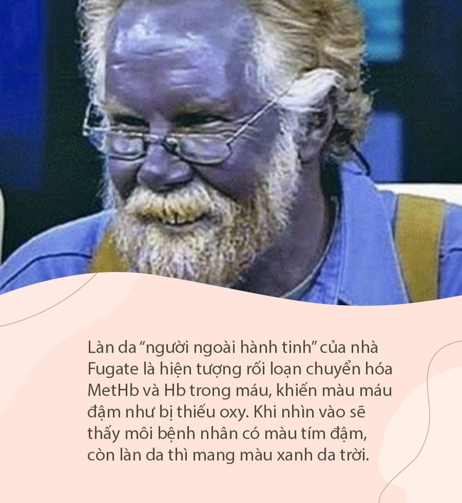 Bí ẩn căn bệnh làm một gia tộc bị cả thế giới cô lập vì làn da xanh, đi đâu cũng bị gán mác &quot;người ngoài hành tinh&quot; và phải sống tủi nhục - Ảnh 4.