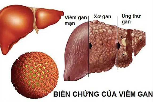 Chàng trai trẻ đau bụng đột ngột, đi khám thì hốt hoảng khi chỉ số chức năng gan vượt 200 lần, nguyên nhân hóa ra là từ người vợ - Ảnh 3.