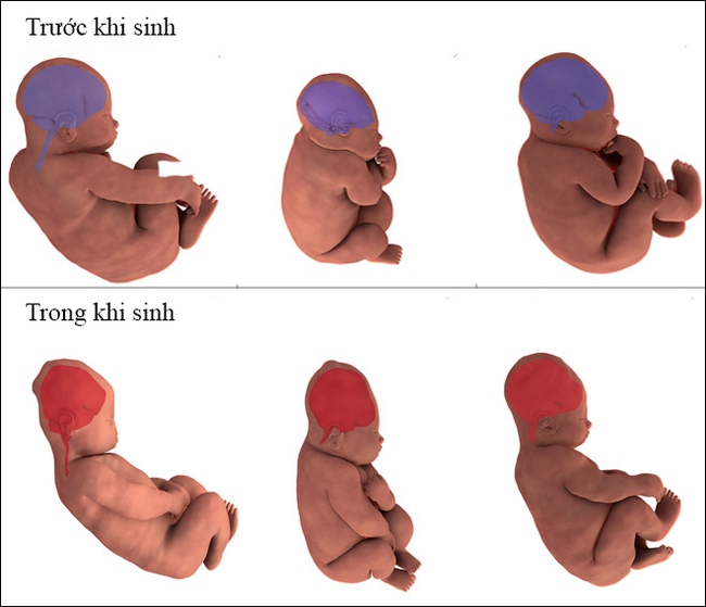 Kinh ngạc với hình ảnh MRI cho thấy đầu của em bé đã &quot;biến dạng&quot; như thế nào khi mẹ sinh thường - Ảnh 2.