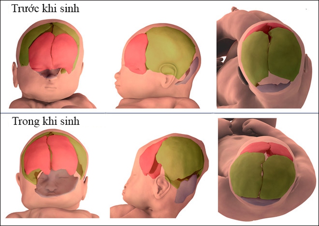 Kinh ngạc với hình ảnh MRI cho thấy đầu của em bé đã &quot;biến dạng&quot; như thế nào khi mẹ sinh thường - Ảnh 3.