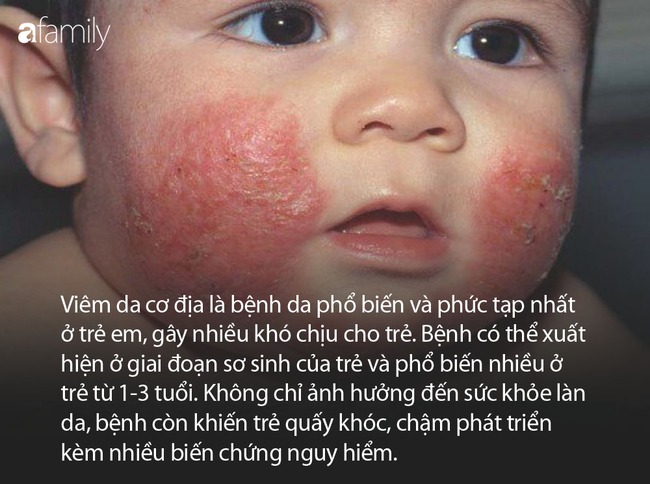 Hành trình 3 năm chữa bệnh vất vả của cậu bé bị chàm da từ lúc 3 tháng tuổi - Ảnh 9.