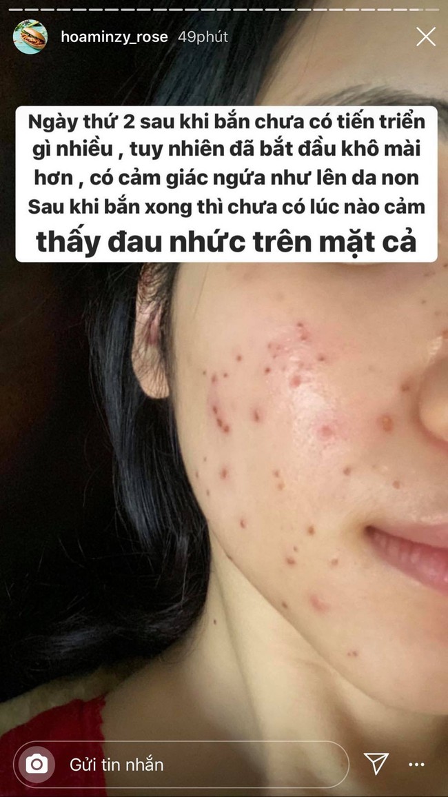 Hòa Minzy gây sốc khi để lộ gương mặt toàn nốt đỏ li ti, nhìn qua đã thấy rùng mình - Ảnh 3.