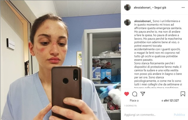 Nữ y tá với vết bầm trên mặt lột tả cuộc chiến khốc liệt chống Covid-19 ở Italy: Ngủ gục trên bàn vì quá mệt, không thể đi vệ sinh hay uống nước suốt 6 giờ - Ảnh 1.
