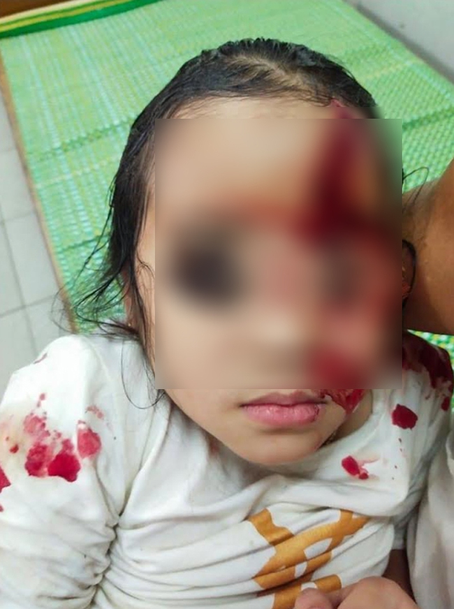 Bị chó cắn rách mặt, bệnh nhi 6 tuổi nhập viện trong tình trạng lo sợ, hoảng loạn - Ảnh 1. Bị chó cắn rách mặt, bệnh nhi 6 tuổi nhập viện trong tình trạng lo sợ, hoảng loạn - Ảnh 1.