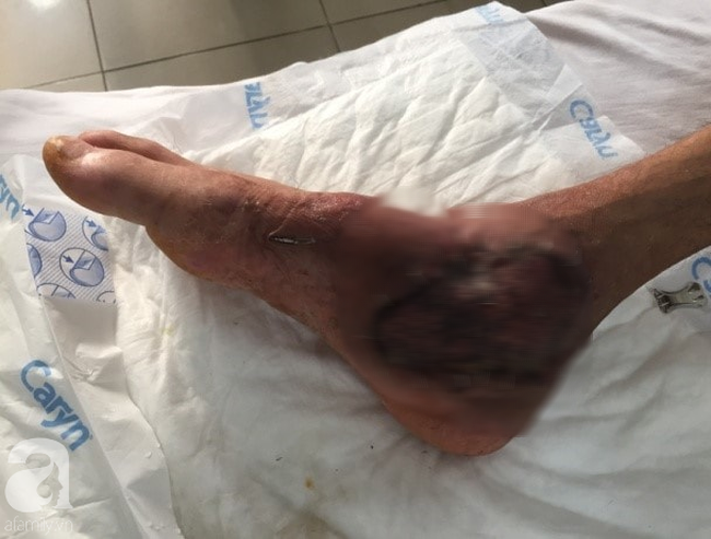 Một bệnh nhân suýt mất chân do điều trị thuốc nam tại nhà - Ảnh 1.