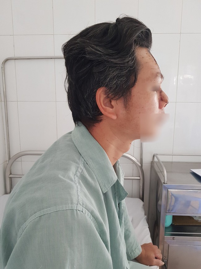 Tái tạo mũi cho bệnh nhân nam ung thư bị xâm lấn đường thở - Ảnh 1. Tái tạo mũi cho bệnh nhân nam ung thư bị xâm lấn đường thở - Ảnh 1.