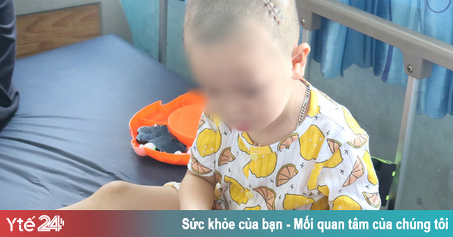 Ngã từ trên gác cao 3m xuống đất, bé trai bị lõm sọ - Ảnh 1.