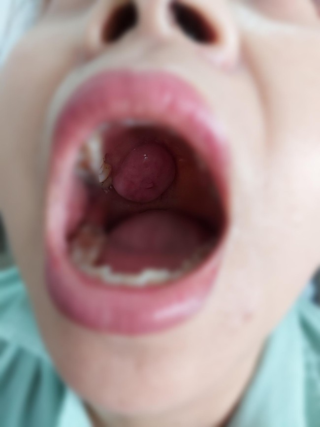 Mang khối u trong miệng đã 3 năm nhưng chủ quan, đến khi giọng nói biến đổi cô giáo Hà Nội đi khám mới biết mình có nguy cơ bị ung thư  - Ảnh 1.
