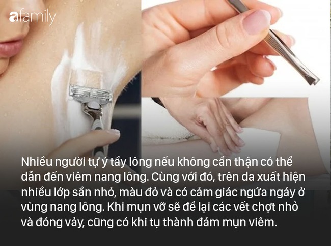 Nhiều lông tay, lông chân khiến chị em thấy thật xấu xí, bác sĩ chỉ ra 2 nhóm các phương pháp tẩy lông, triệt lông cho chị em lựa chọn - Ảnh 2.