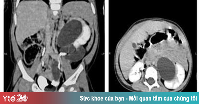 Hy hữu: Bé gái 1 tuổi có tới 3 quả thận, 3 ống niệu quản - Ảnh 1. Hy hữu: Bé gái 1 tuổi có tới 3 quả thận, 3 ống niệu quản - Ảnh 1.