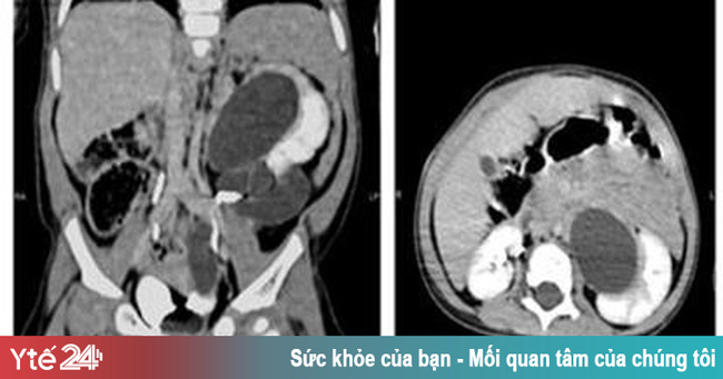 Hy hữu: Bé gái 1 tuổi có tới 3 quả thận, 3 ống niệu quản - Ảnh 1.