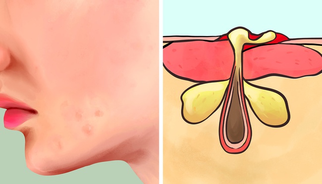 Phân biệt 6 loại mụn trứng cá từ nhẹ đến nặng: Nguyên nhân gây mụn và cách xử lý hiệu quả nhất - Ảnh 6.