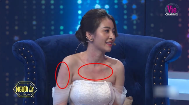 &quot;Người ấy là ai?&quot;: Khán giả xót xa trước hình ảnh nữ chính Huyền Thoại nổi mẫn đỏ trên ngực và tay trong suốt chương trình - Ảnh 2.