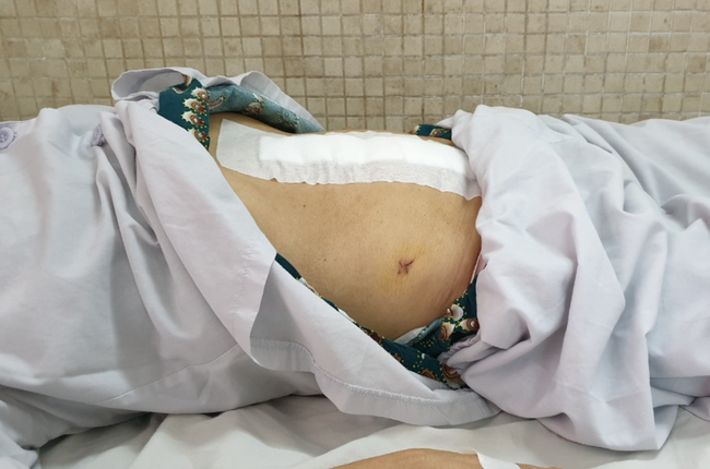TP.HCM: Phẫu thuật cứu người phụ nữ bụng như mang thai 9 tháng vì khối u to khủng khiếp này - Ảnh 4.