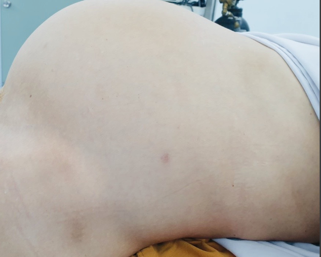 TP.HCM: Phẫu thuật cứu người phụ nữ bụng như mang thai 9 tháng vì khối u to khủng khiếp này - Ảnh 2.