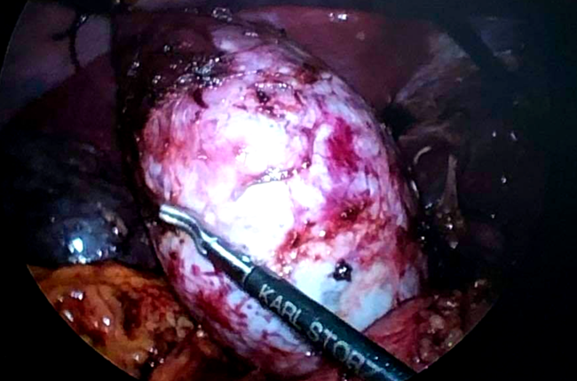 Đục 3 lỗ phẫu đưa đèn và dao mổ vào bụng cứu 2 bé gái sơ sinh bị căn bệnh nguy hiểm này - Ảnh 2.