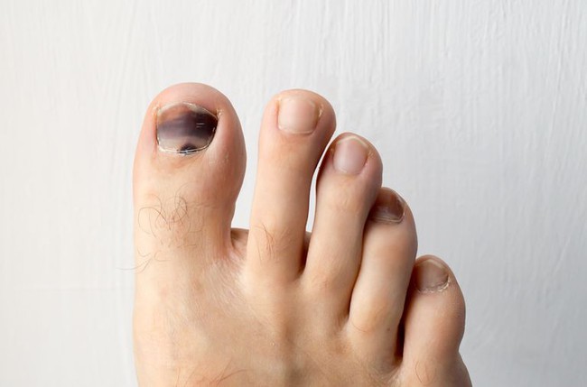 Nguyên nhân phổ biến khiến móng chân chuyển màu đen - Ảnh 1.