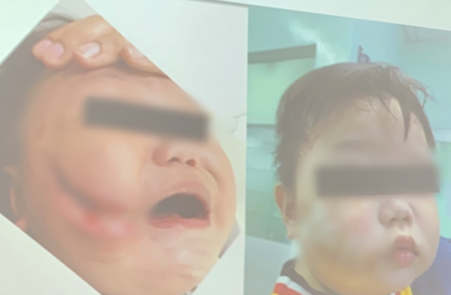 Thương tâm: Đang ăn xúc xích, cháu bé 17 tháng tuổi bị chó hàng xóm ngoạm nát mặt - Ảnh 4.