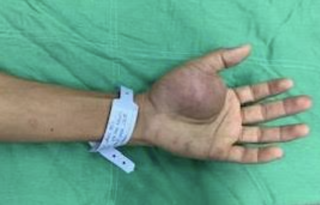 Chàng trai 29 tuổi mang khối bướu nguy hiểm ở bàn tay nhưng nếu mổ bỏ đơn thuần sẽ chảy máu không kiểm soát - Ảnh 1.
