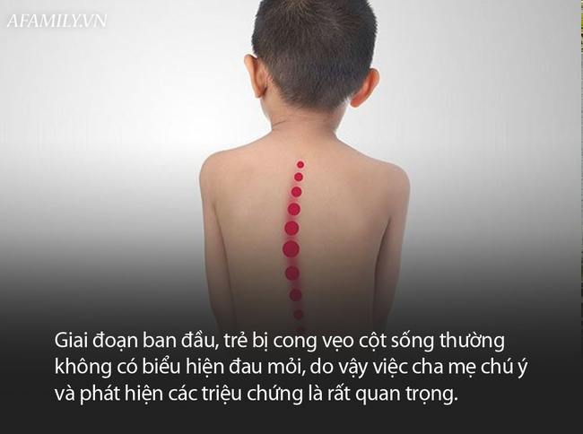 Bé 4 tuổi đã bị cong vẹo cột sống, bác sĩ cảnh báo &quot;Hãy dành ra 5 phút mỗi ngày để ngắm con một cách cẩn thận!&quot; - Ảnh 4.