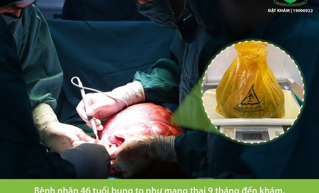 Thấy bụng chướng dần, to lên nhưng chủ quan không đi khám người phụ nữ Hà Nội mang trong mình khối u xơ tử cung nặng hơn 10kg - Ảnh 1.