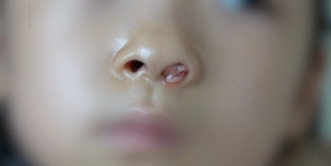 Bé gái 2 tuổi ngã đập mặt xuống đất gãy cả răng, 4 năm sau bác sĩ kinh ngạc khi phát hiện điều kỳ lạ chưa từng thấy trong mũi  - Ảnh 2.