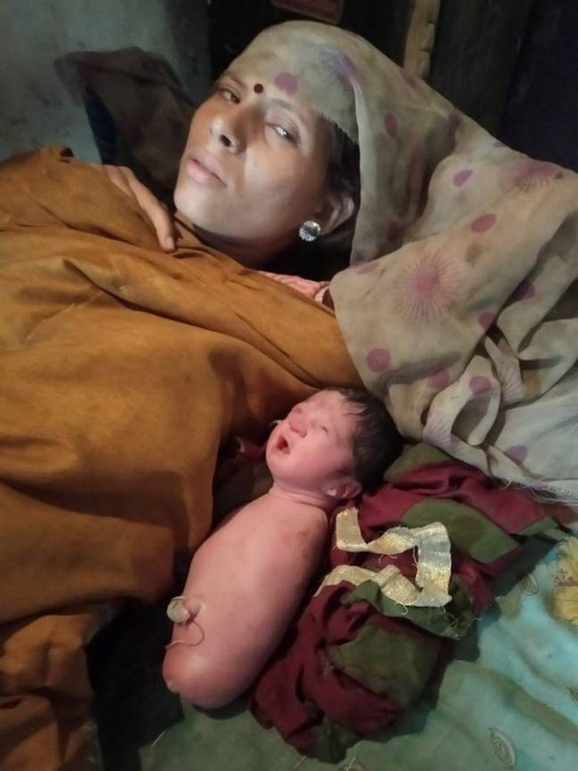 Ca sinh ở Ấn Độ với tỉ lệ dị tật cực kì hiếm khiến đến cả bác sĩ cũng phải ngỡ ngàng - Ảnh 1.