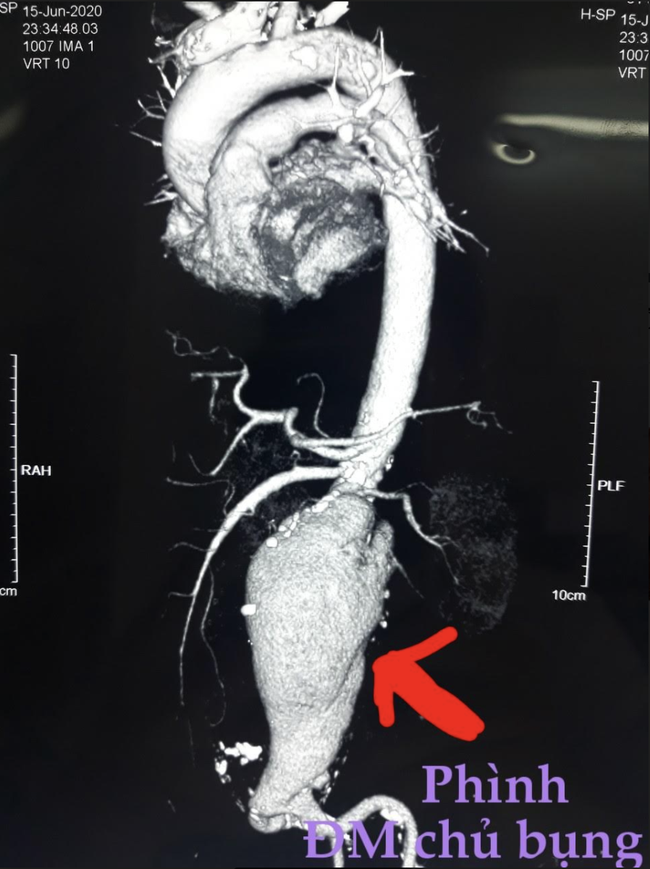 Hàng loạt bệnh nhân bị vỡ túi phình động mạch chủ bụng nguy kịch: Ai hay hút thuốc lá, ăn nhiều mỡ hãy cẩn thận! - Ảnh 1.