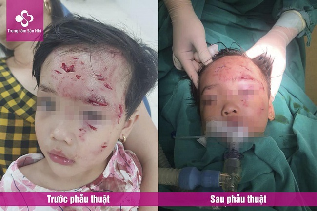 Bé gái 3 tuổi bị chó nhà hàng xóm cắn nhiều vết thương nặng, phức tạp vùng hàm mặt - Ảnh 1. Bé gái 3 tuổi bị chó nhà hàng xóm cắn nhiều vết thương nặng, phức tạp vùng hàm mặt - Ảnh 1.