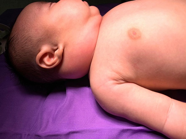 Kịp thời phát hiện trẻ 02 tháng tuổi bị áp xe lớn vùng góc hàm hiếm gặp - Ảnh 1.