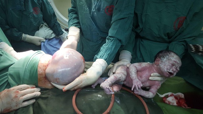 Hy hữu: Sản phụ Quảng Ninh sinh đôi, một trong hai bé còn nguyên trong túi ối - Ảnh 1.