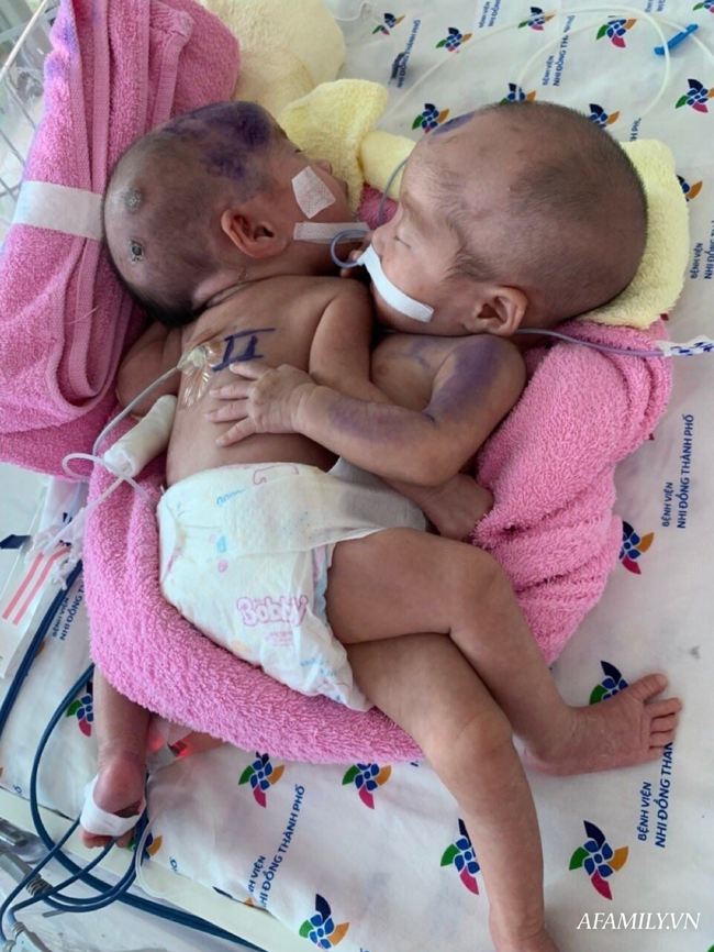 Hai bé gái song sinh dính nhau vùng bụng chậu khỏe mạnh đùa giỡn trước ngày thực hiện ca phẫu thuật định mệnh - Ảnh 2.