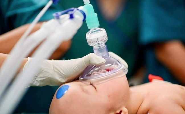 Ý nghĩ về hai dấu chấm tròn màu xanh, đỏ trên trán của hai em bé song sinh trong ca phẫu thuật tách rời - Ảnh 2.