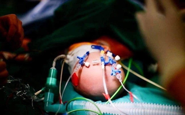 Ý nghĩ về hai dấu chấm tròn màu xanh, đỏ trên trán của hai em bé song sinh trong ca phẫu thuật tách rời - Ảnh 4.