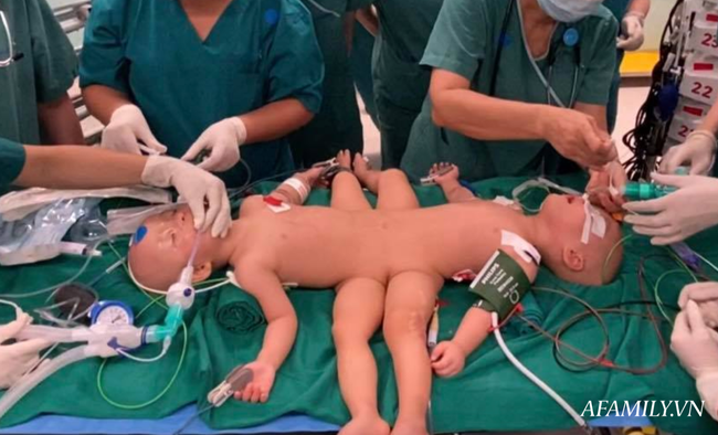 Xúc động từng khoảnh khắc ca phẫu thuật tách rời hai bé dính nhau: Nhừng đường rạch da cân não từ 5 ekip bác sĩ - Ảnh 8.