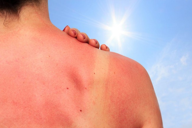 Vết cháy nắng có thể tồn tại bao lâu trên da và biện pháp giúp da lành nhanh hơn - Ảnh 1.