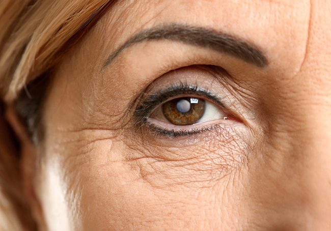 Đục thủy tinh thể là gì và những điều bạn cần biết về căn bệnh về mắt phổ biến này - Ảnh 2.