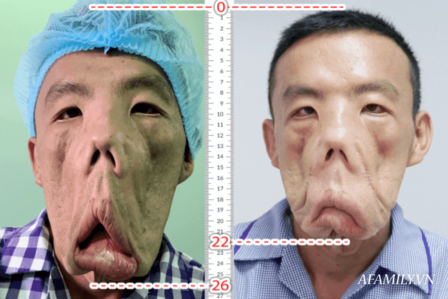 Bác sĩ Sài Gòn tìm cách cứu người đàn ông mang bộ mặt quái dị, 15 năm ngủ ngồi và mắt luôn đỏ như máu - Ảnh 8.